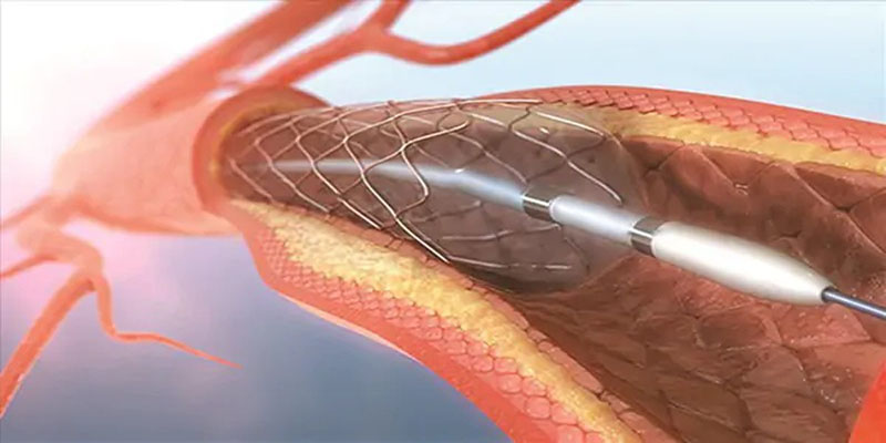 dat-stent-tim-mach